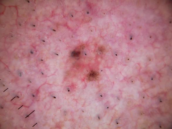 lesions (40%) Path: 4 MMIS, 3 severely DN, 4 Atypical mel lesions 60% of cases spared bx bc RCM benign! Song, Grant-Kels, Swede, et al. JAAD 2016;75:1187-92.