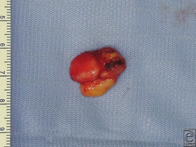 KITAZAWA AND SHIBA CD34. On the basis of these findings, the tumor was diagnosed as an osteochondrolipoma (Fig 4). Six months after surgery, there was no recurrence of the disease. Figure 3.