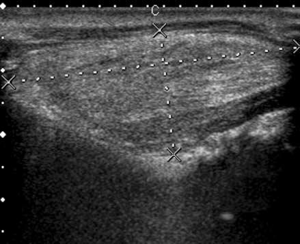 Aggressive Thenar Intramuscular Lipoma A Figure 1.