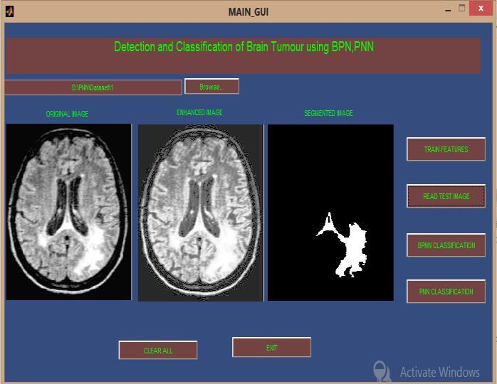 with the desired values of neural networks to determine the MRI image belong to which grade of brain tumor.