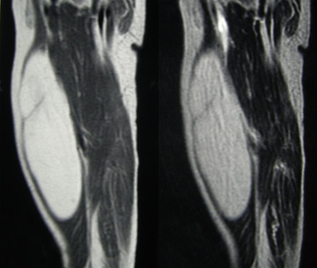 Fig. 4: MRI of typical lipoma. Sagittal view, T1 and T2 weighted sequences.