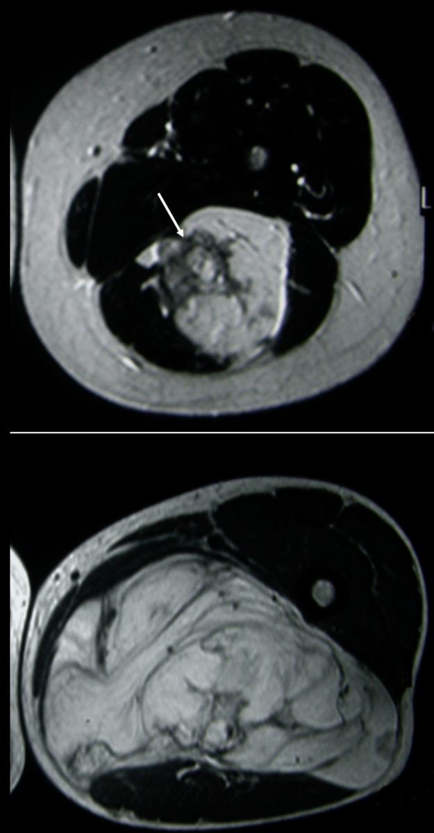 Fig. 5: T2-weighted MR of lipomas with septa, foci