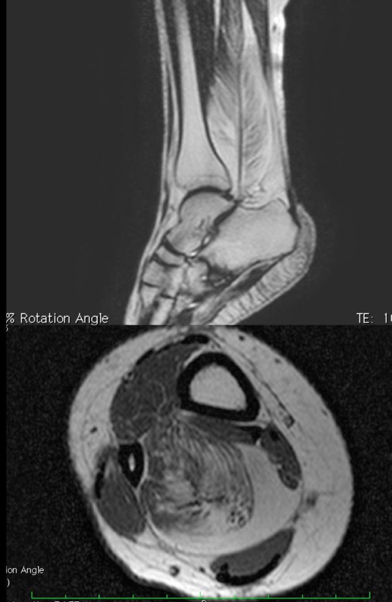 Fig. 7: T2- weighted sagittal and T1-weighted axial MRI examination of intramuscular