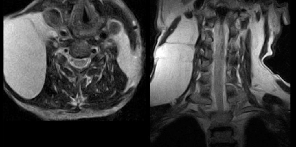 Fig. 8: T2-weighted MRI examination in axial and coronal views with extensive