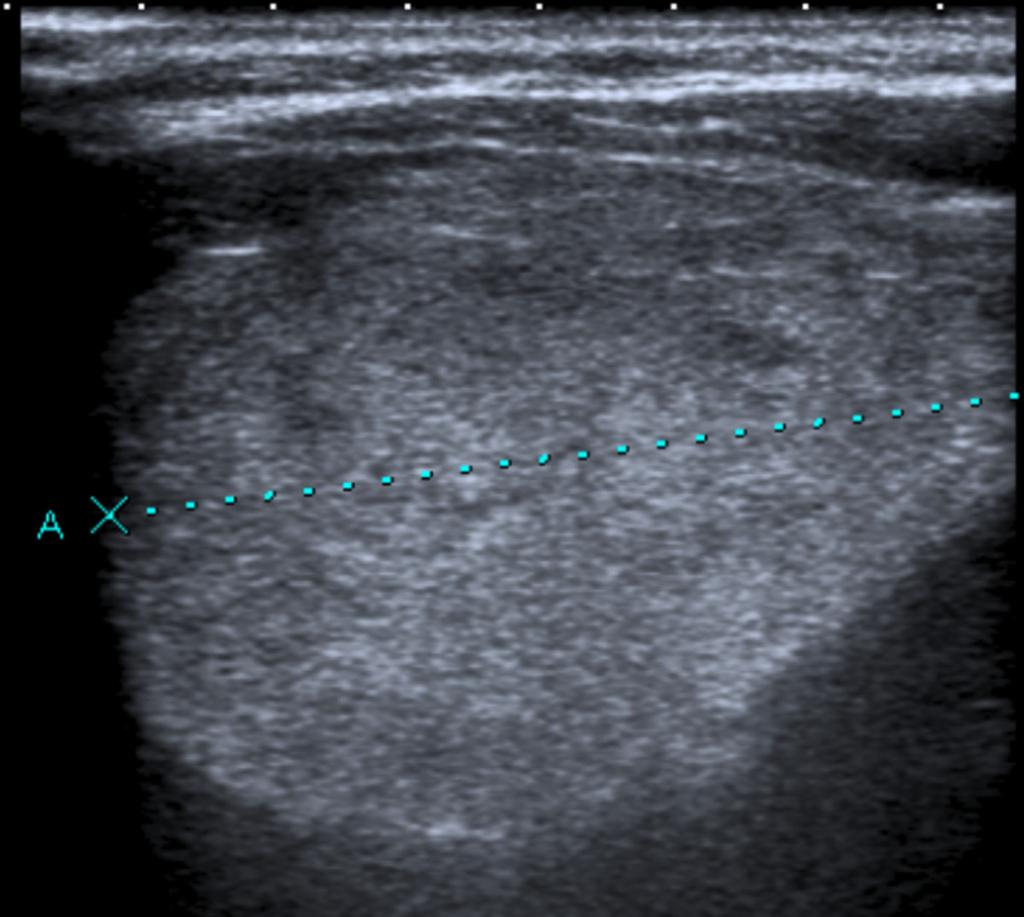 Fig. 9: Ultrasound examination, sagittal view of lipoblastoma. 6 year-old patient with palpable lump on right shoulder.