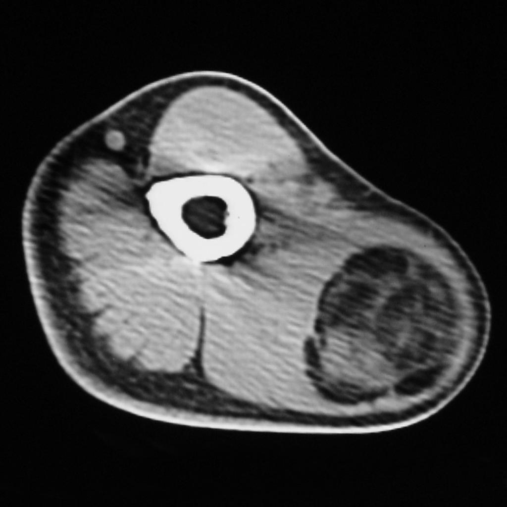 Fig. 10: Unenhanced axial CT examination of a 5 year-old patient with lipoblastoma.