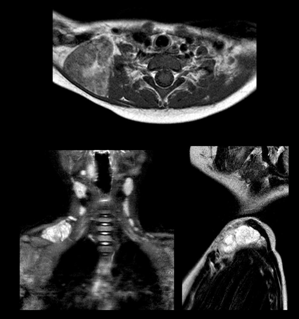 Fig. 11: MRI characteristics of lipoblastoma. Same patient of figure 9. MRI examination with axial T1-weighted, coronal STIR and sagittal T2-weighted sequences.