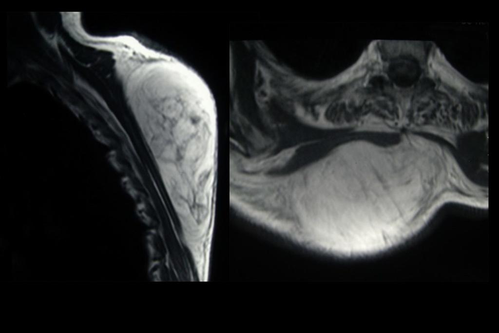 Fig. 13: Coronal and axial T1-weighted image shows a subcutaneous well-defined fatty mass with