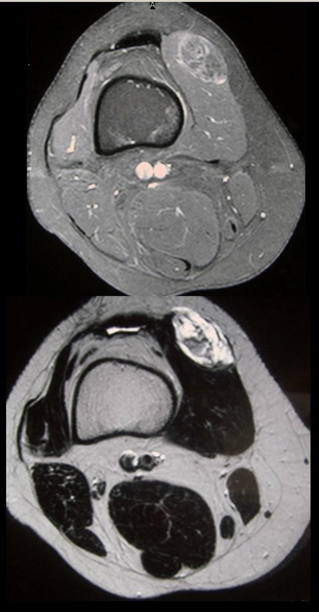 Fig. 14: MRI of thigh with small myolipoma of the quadriceps compartment.