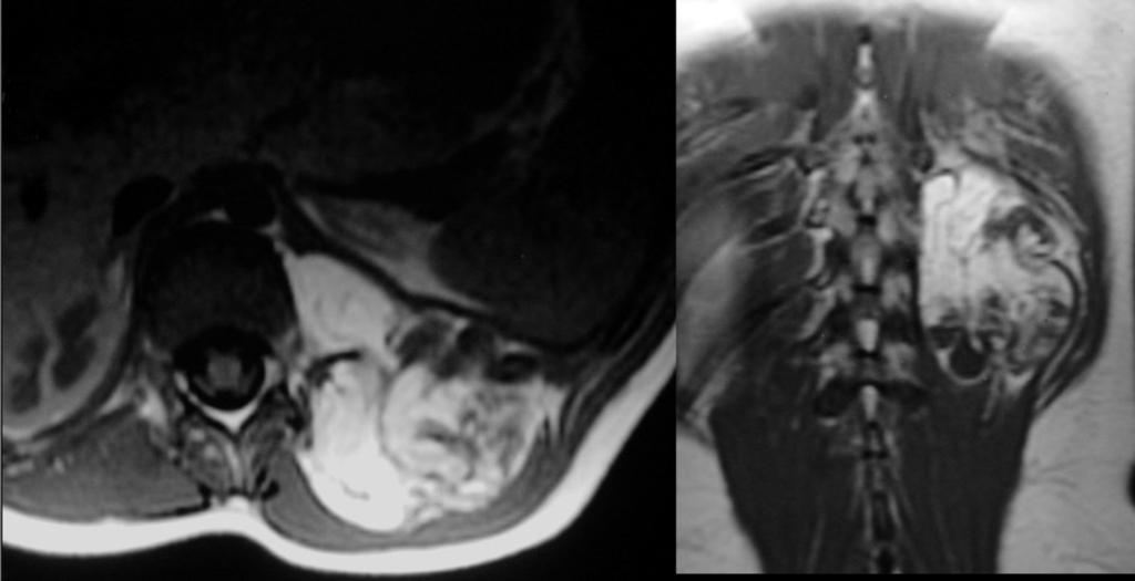 Fig. 15: MRI of pleomorphic lipoma.