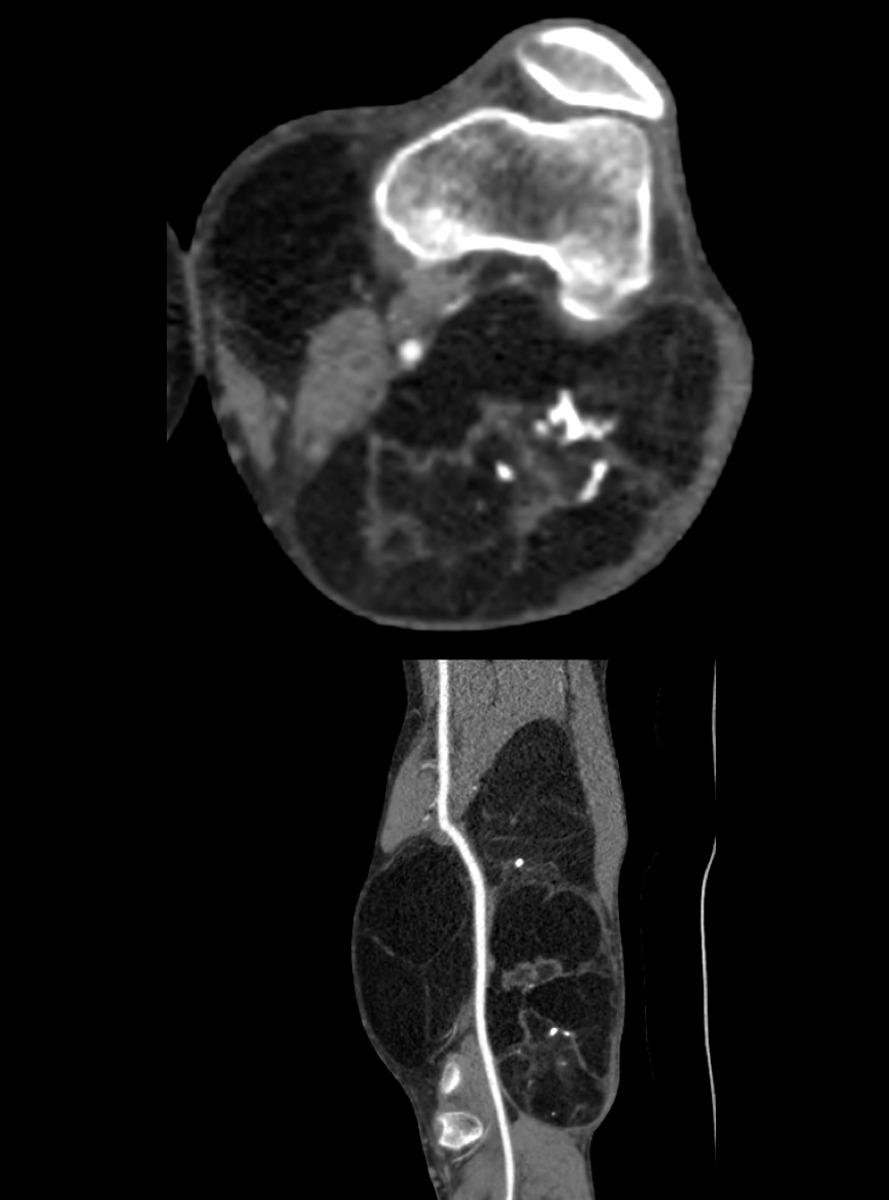 Fig. 16: Chondroid lipoma appearing as a giant well-defined mass of the posterior aspect