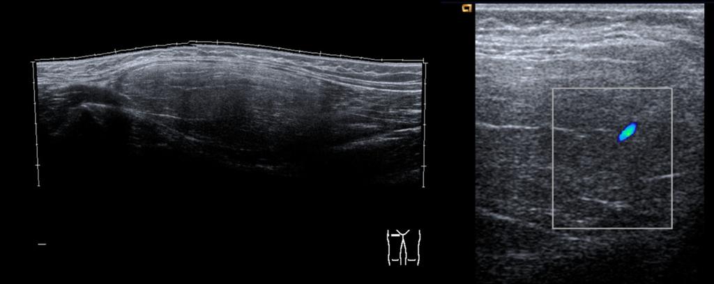 Fig. 17: Ultrasound characteristics of hibernoma of the right thigh.
