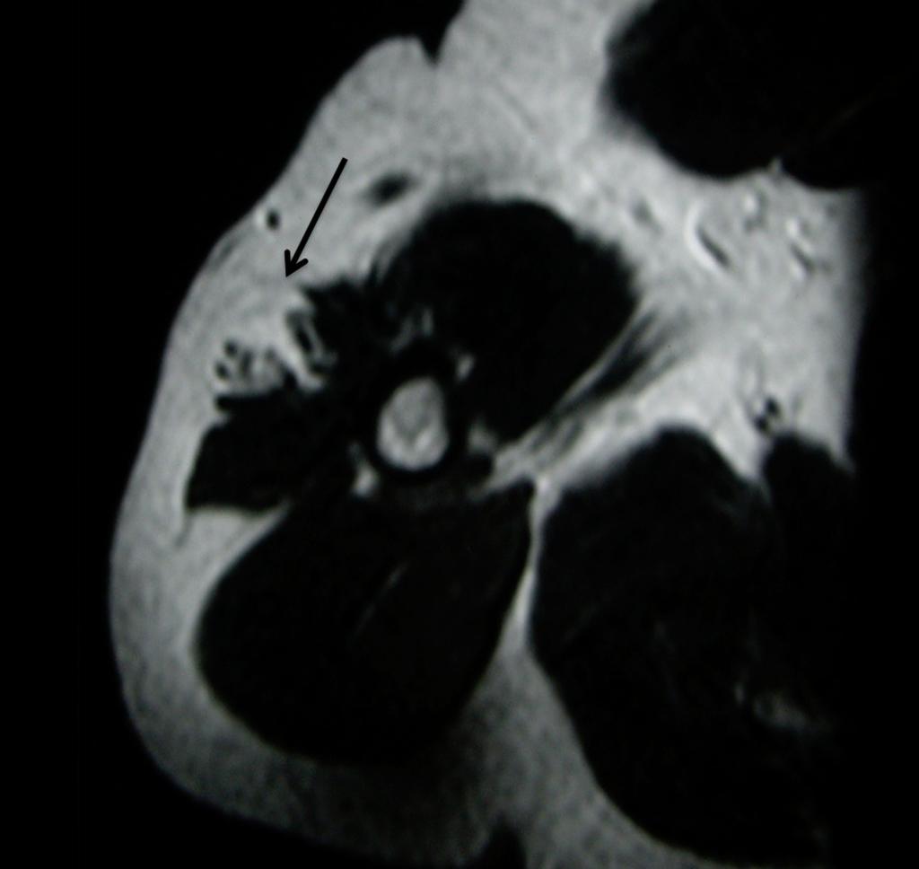 Fig. 18: T2-weighted MRI of small hibernoma of deltoid muscle, with a thin
