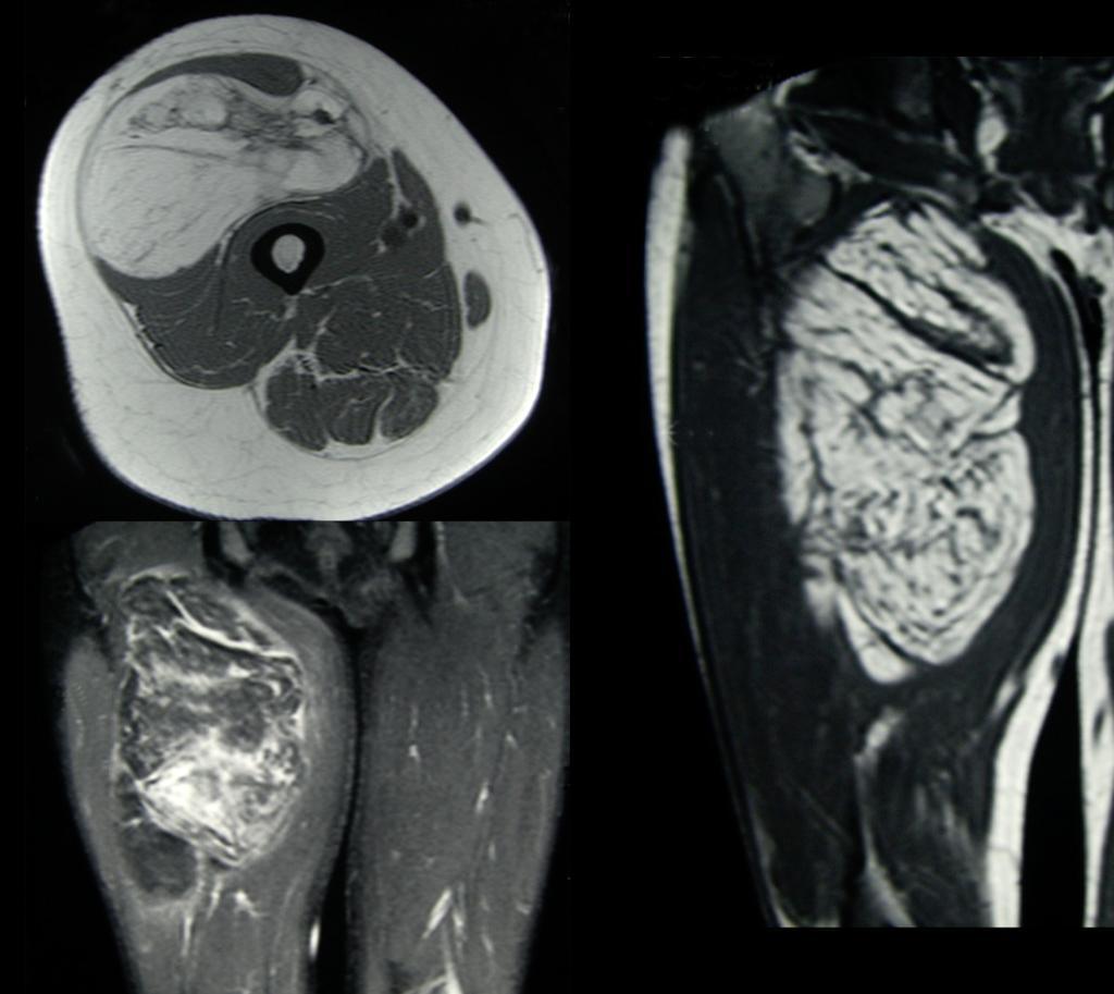 Fig. 20: MRI with axial T1-weighted, coronal T2 and STIR sequences of a well differentiated liposarcoma