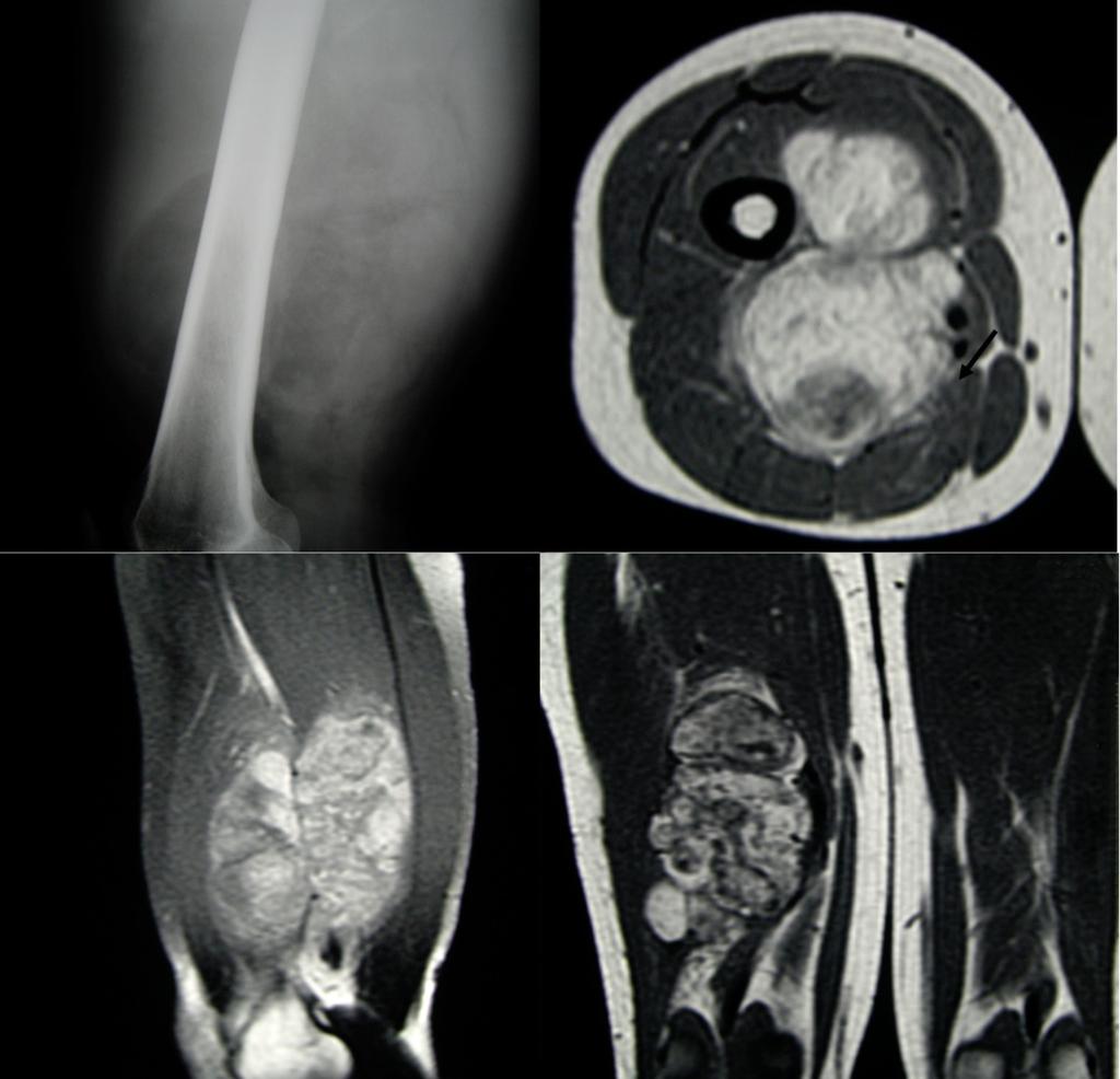 Fig. 21: Well differentiated liposarcoma: Thigh X-ray with a posteriorly located radiolucent mass.