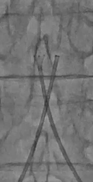 Stenting by two opeartor Sometimes do not