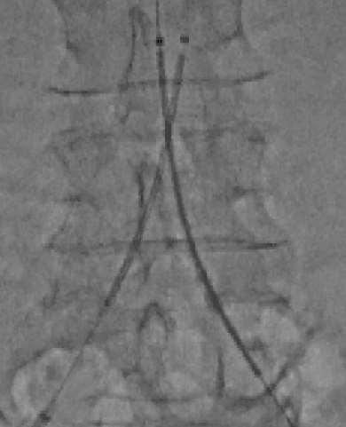 Stenting by one operator 1. Place one stent by a little length. 2.