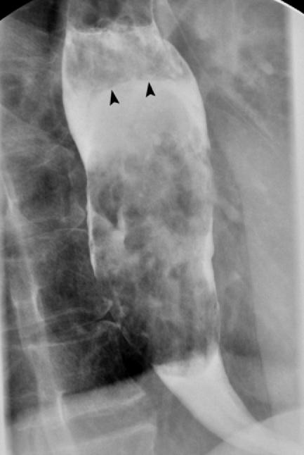 proximal esophagus. Figure 4.
