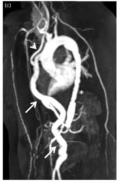 renal artery stenosis isolated