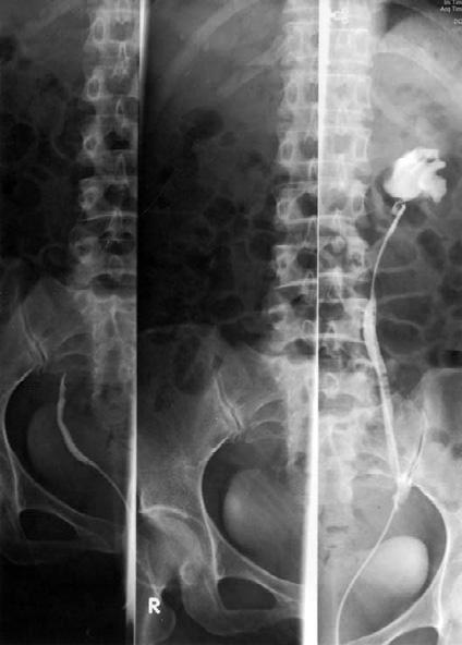 H.C. Juan, H.C. Yeh, H.L. Hsiao, et al Figure 1. Retrograde pyelogram demonstrates obstruction of the right distal ureter with the proximal third of the left ureter showing redundant kinking.