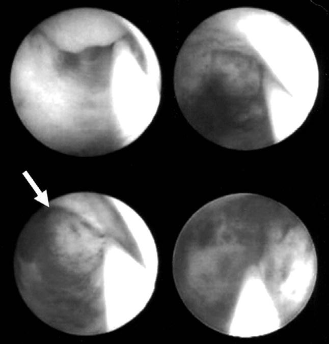 Retrograde pyelography demonstrated hydronephrosis and partial obstruction of the right ureter in the distal third, together with a filling defect in the distal third and proximal third of the left