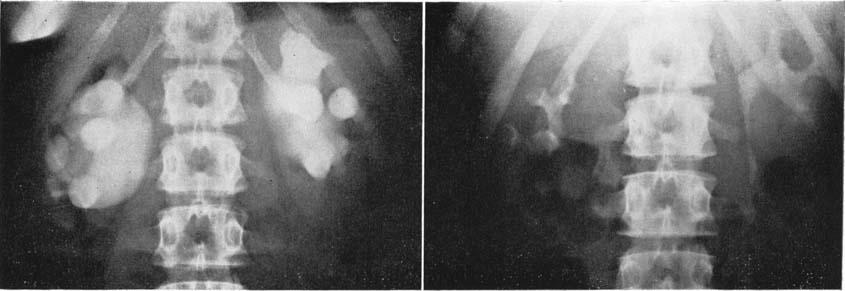 , aged I3 years (see d o Fig. 3). Left hydronephrosis.