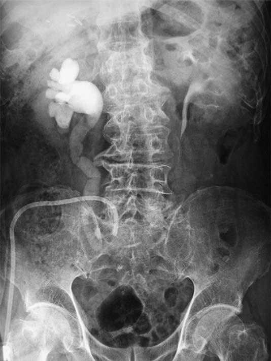 876 Fig. 1 Preoperative antegrade pyelography revealing right hydronephrosis and right ureteral obstruction near the ileal conduit.
