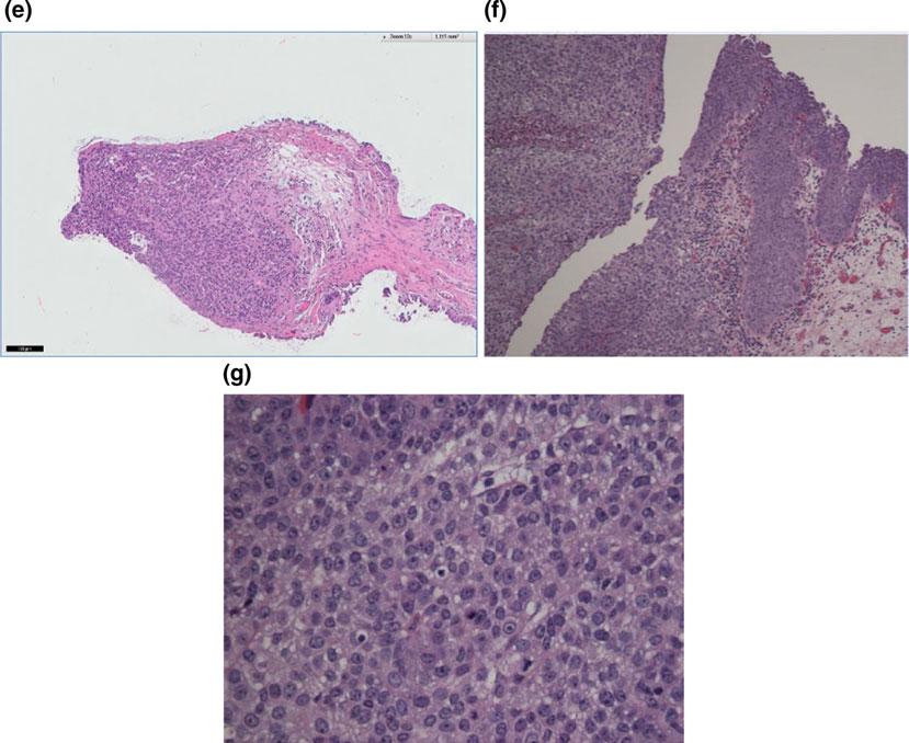 Case Studies: A Spectrum of Upper Tract Urothelial Carcinoma 351 Fig. C.19 (continued) strong history of several malignancies, with an excellent outcome.