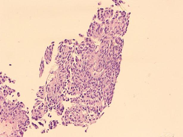 23 Left kidney upper calyx biopsy showing low-grade