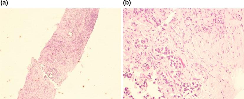 Case Studies: A Spectrum of Upper Tract Urothelial Carcinoma 359 Fig. C.31 a, b 2012 CT scan guided renal biopsy of left upper pole mass consistent with infiltrative high-grade urothelial carcinomas Fig.