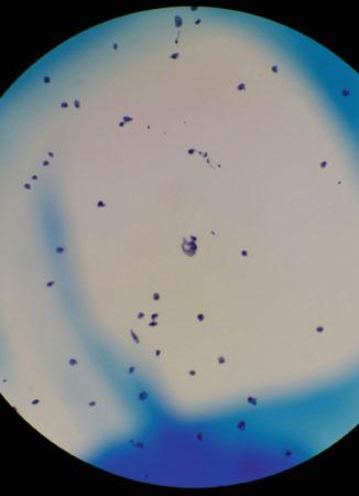 44 Urine cytology showing malignant cells Fig. C.