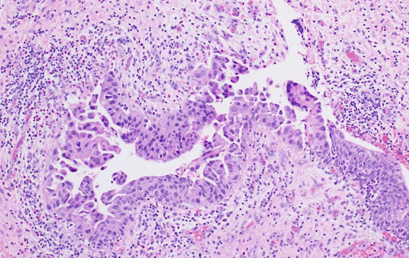Case Studies: A Spectrum of Upper Tract Urothelial Carcinoma 367 Fig. C.49 Section through the transplant renal pelvis in the same patient shows similar findings and serum creatinine was 1.