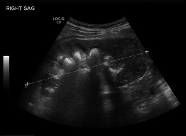 368 Case Studies: A Spectrum of Upper Tract Urothelial Carcinoma liver, and omentum.