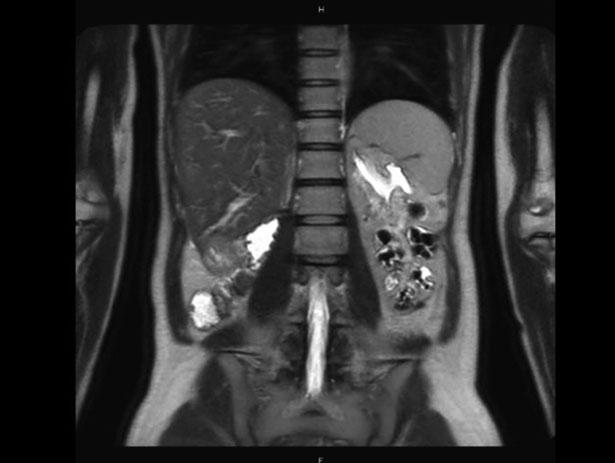 370 Case Studies: A Spectrum of Upper Tract Urothelial Carcinoma Fig. C.54 2014 MRI of the abdomen demonstrating the *3.