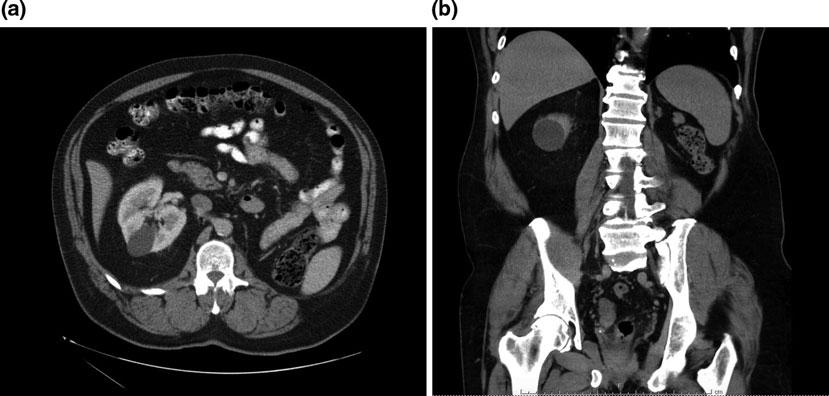 Case Studies: A Spectrum of Upper Tract Urothelial Ca
