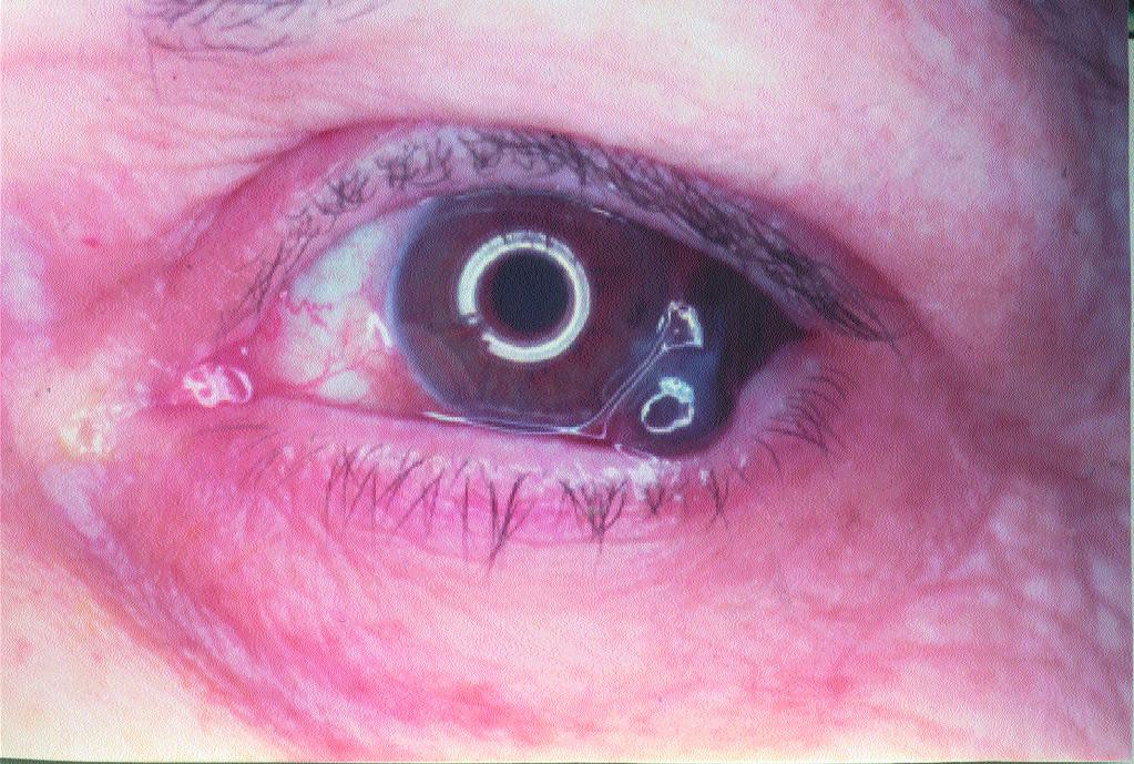 MATERIALS AND METHODS Between March 1999 and October 2002, four consecutive patients with large conjunctival melanoma were ref e r red to our institution.