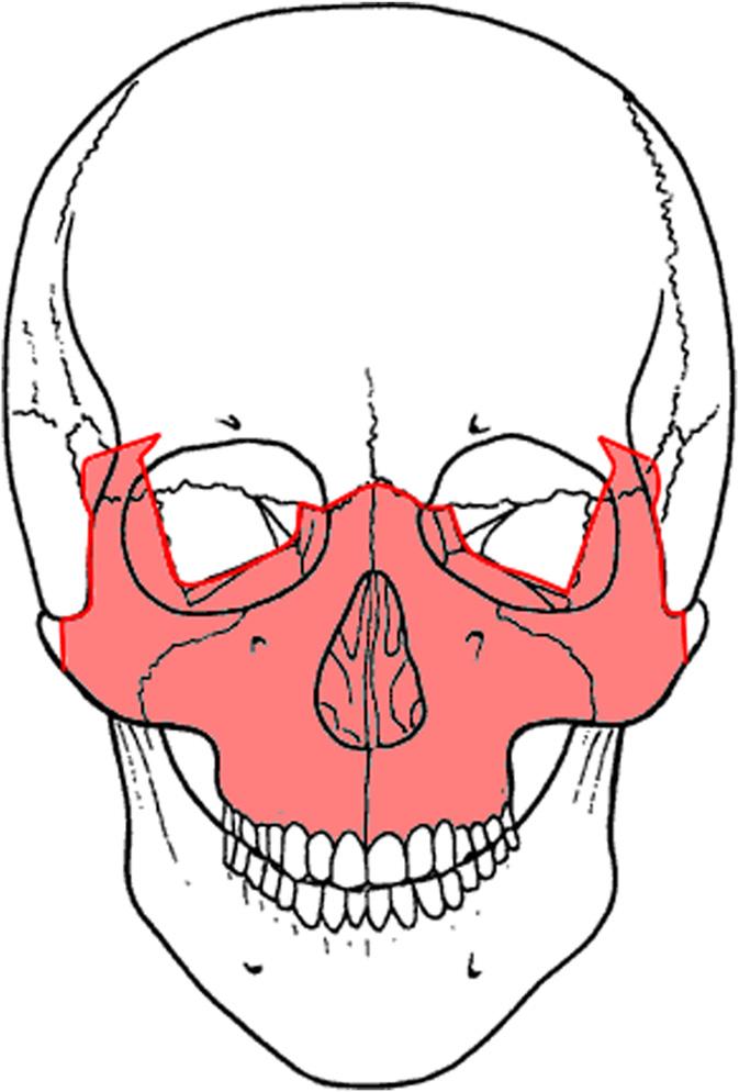 224 E. Nout et al. / Journal of Cranio-Maxillo-Facial Surgery 40 (2012) 223e228 evaluated. Patients were included when the pre- and post-operative CT-scans were available for analysis. 2.2. CT-scans The CT-scans were carried out in a supine position using the same scanner (Emotion 6, Siemens, Munich, Germany) and had a slice thickness of 1.