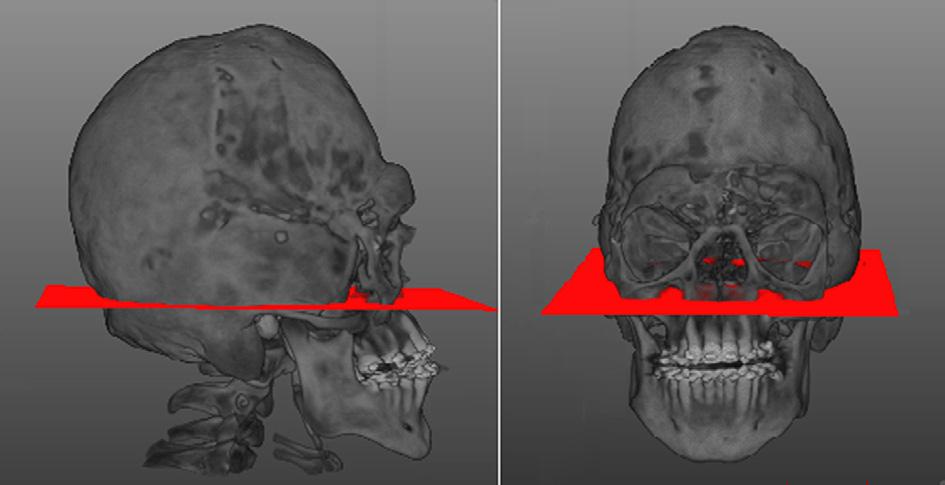E. Nout et al. / Journal of Cranio-Maxillo-Facial Surgery 40 (2012) 223e228 225 Fig. 3.