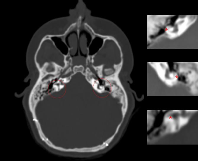 Axial slice of one of the patients in which the anatomical localization of the lateral semicircular canals (LSCC) is visualized (red circles).