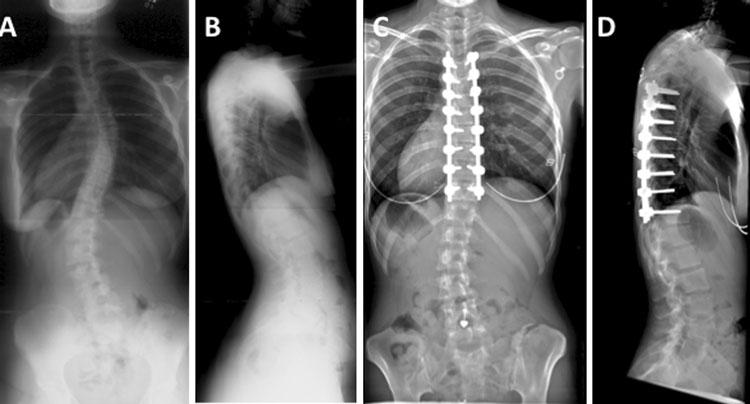 correction to 15, d and 19 of post-operative kyphosis Discussion Early spinal instrumentation to correct scoliosis primarily targeted improvement in alignment of the coronal plane.