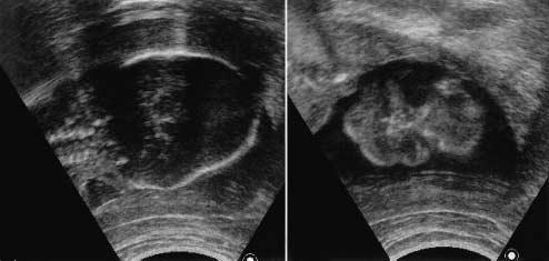 Figure 1 The norml ppernce of the fetl skull ws noted in the reech-presented fetus t 19 weeks of gesttion ().