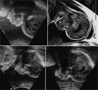 c d Figure 3 The sonogrphic chnges of the fetl profile t 22 weeks (), 27 weeks () nd 35 weeks of gesttion (c). Frontl ossing nd low nsl ridge grdully progressed with the gesttion.
