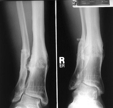 Malunion: Treatment by type Angulation Acute or gradual correction possible Acute correction Dome osteotomies well suited for juxtaarticular deformities Wedge osteotomies work well in diaphyseal