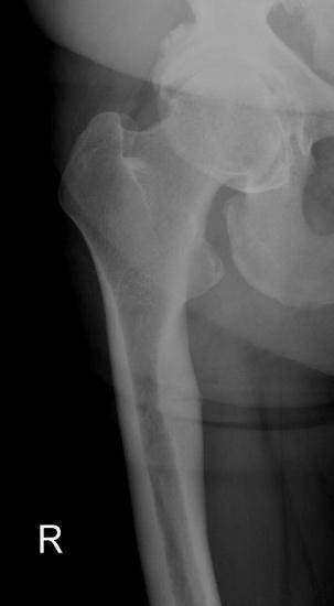 Rickets Bowing deformities Bone pain Insufficiency