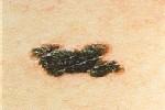 Malignant Melanoma Fair skinned increasing in incidence, related to sun exposure asymmetrical, irregular borders & painless scaling, scabbing & may bleed grows