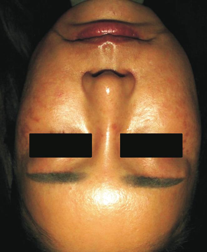 Invasive Pulsed Bipolar Radiofrequency Hyoung Moon Kim and Min Ji Lee RESULTS Over 1 year, a total of 142 patients underwent IBPRF treatment for melasma with or without RH.