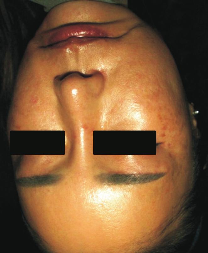Fifteen patients reported having had melasma for less than 1 year, 64 patients stated between 1 to 5 years, and 53 patients reported having melasma for longer than 5 years but less than 10