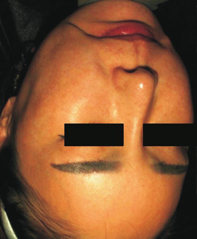 Regarding melasma types, 103 patients presented with melasma of centrofacial type, while the other 27 patients exhibited melasma of malar type.