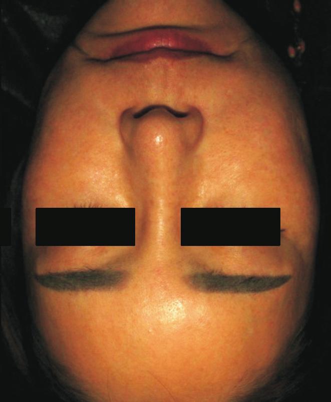 Of these 18 patients, laser toning was most commonly used for melasma treatment, followed by treatment with intense pulsed light or whitening ointment.