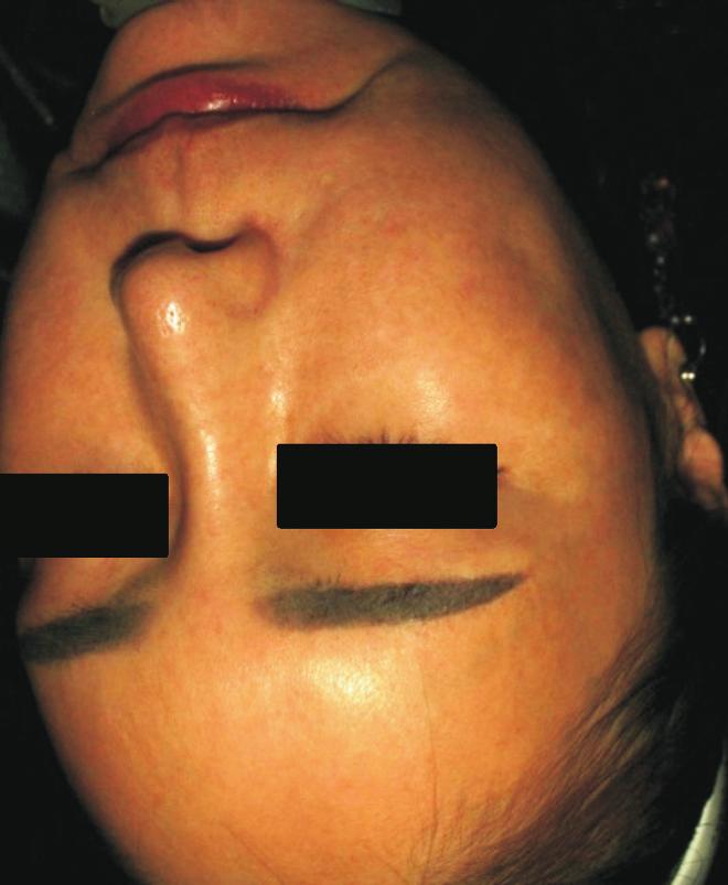 All 18 patients had undergone basic treatment with laser toning combined with other treatment. For melasma treatment, IBPRF alone was administered in 112 subjects.